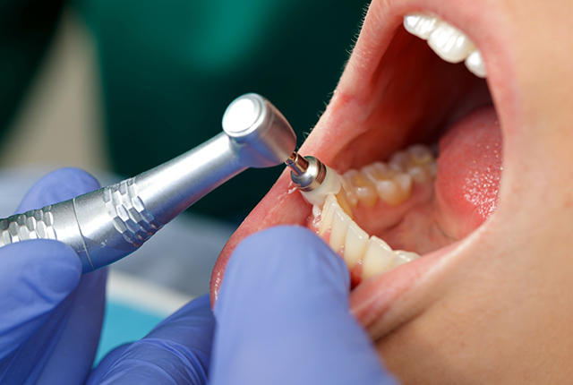 歯のクリーニング