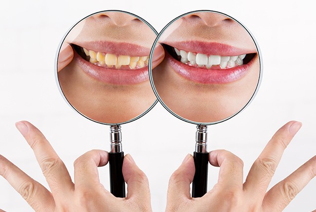 ホワイトニング